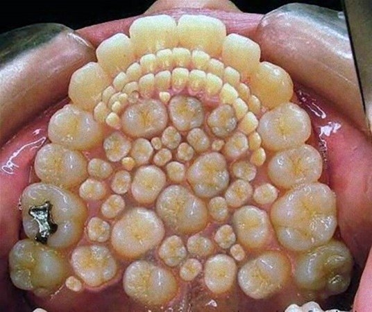 Öyle tuhaf hastalıkları var ki: Ağzından tam 232 diş çıkarıldı! 17