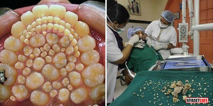 Öyle tuhaf hastalıkları var ki: Ağzından tam 232 diş çıkarıldı! 19