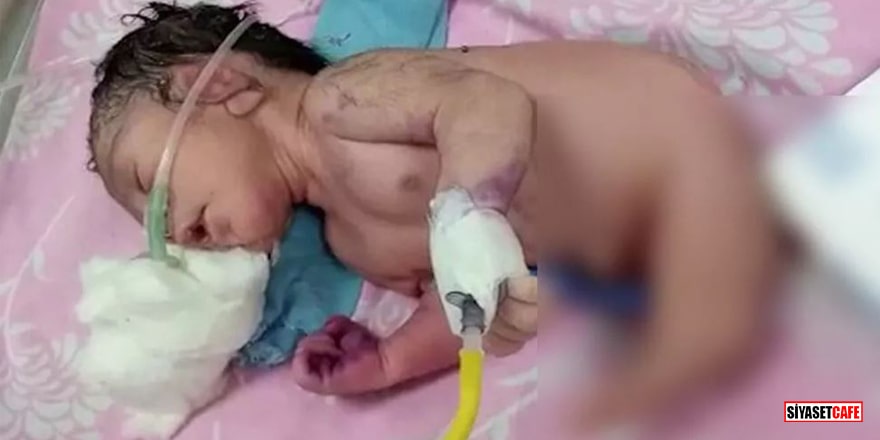Hindistan'da doğan bebek şoke etti! Bacakları yerine boynuzu var