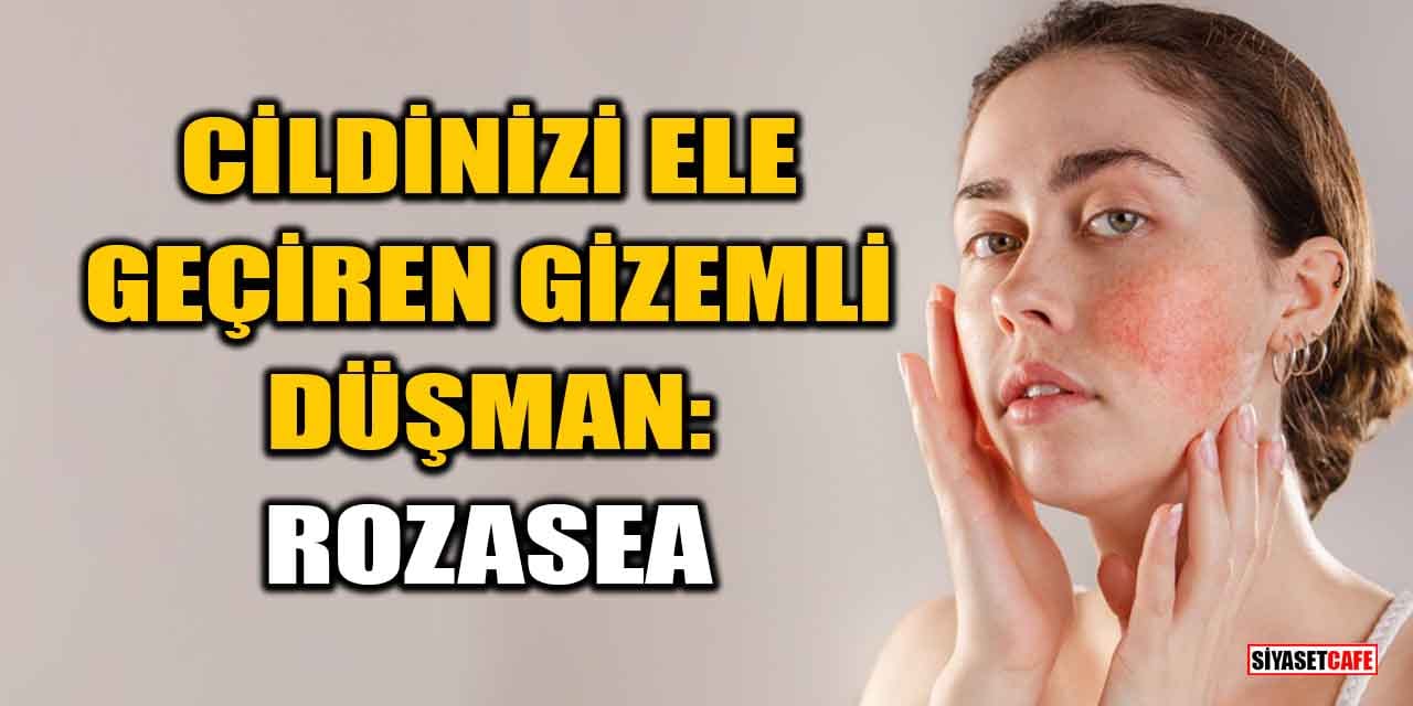 Cildinizi Ele Geçiren Gizemli Düşman: Rozasea