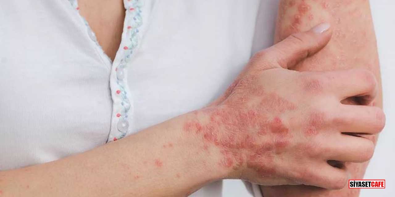Ciltteki İzlerden Organlara Uzanan Sinsi Yolculuk: Lupus