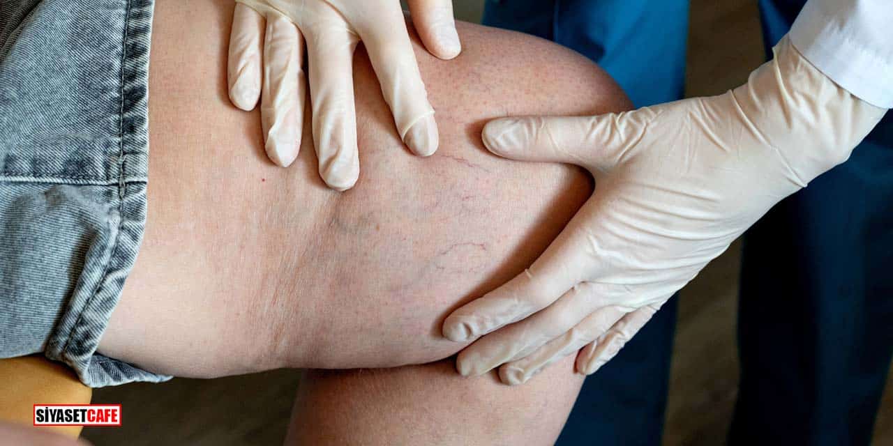 Lipödemden Kurtulmanın Şok Edici 7 Sırrı Ortaya Çıktı!