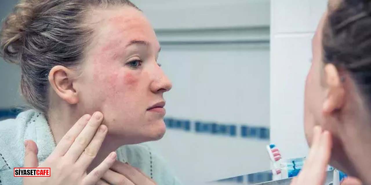 Soğuk Havalarda Cilt Sağlığını Korumanın 9 Pratik Yolu