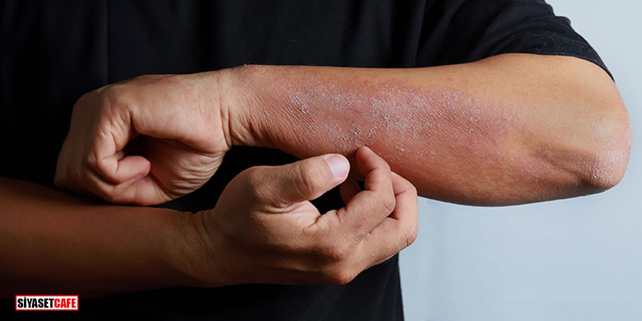 Egzamadan Kurtulmanın Sırrı Banyodan Sonra 3 Dakikada Gizli!