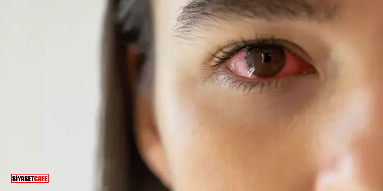Masum Sanılan Göz Kızarıklığı Görme Kaybına Yol Açabiliyor!