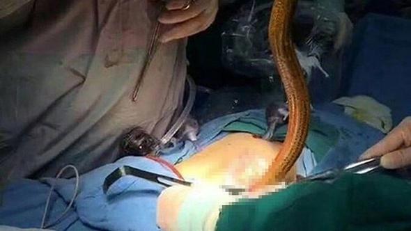 Doktorlar şok oldu: Anüsünden yılan balığı çıktı