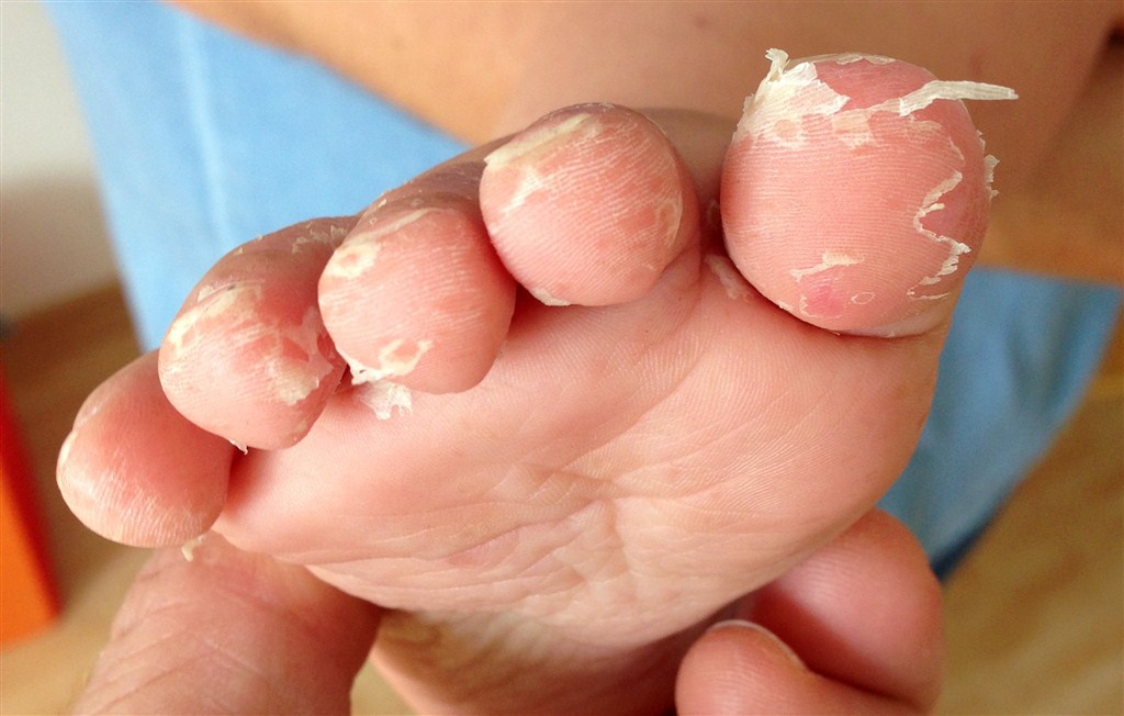 Özellikle çocuklarda görülen el ayak ağız hastalığı