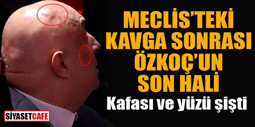 Meclis'teki kavga sonrası CHP'li Özkoç'un kafası ve yüzü şişti