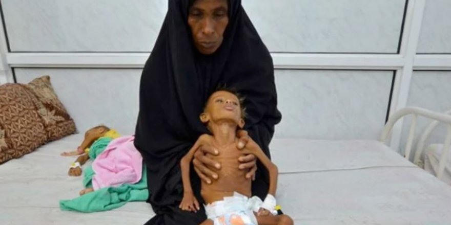Yemen'de açlıktan ölmek üzere olan 400 bin çocuk var